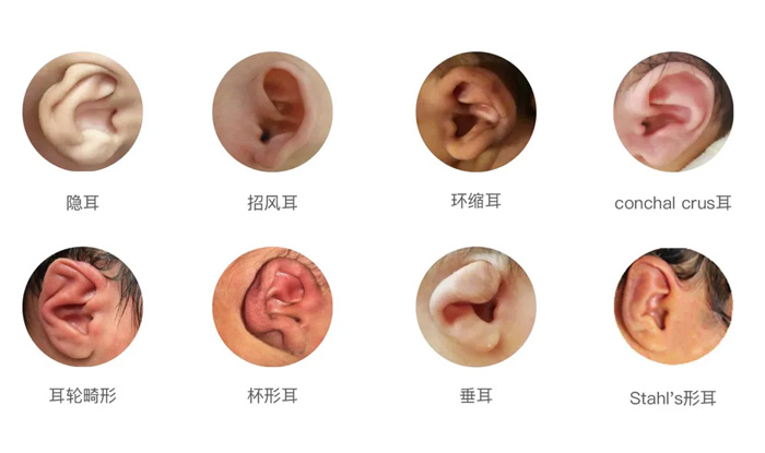 耳廓形態(tài)畸形的種類 耳廓形態(tài)畸形的種類