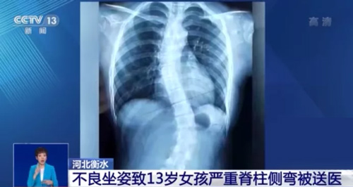 危害兒童青少年健康的第三大疾病脊柱側彎要如何預防? 危害兒童青少年健康的第三大疾病脊柱側彎要如何預防?