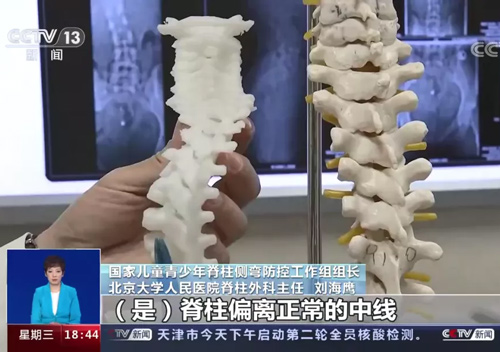 危害兒童青少年健康的第三大疾病脊柱側彎要如何預防? 危害兒童青少年健康的第三大疾病脊柱側彎要如何預防?