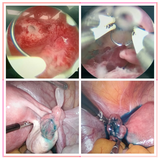 不孕癥患者福音 我院微創(chuàng)婦科宮腹腔鏡技術(shù)科學(xué)助孕! 不孕癥患者福音 我院微創(chuàng)婦科宮腹腔鏡技術(shù)科學(xué)助孕!