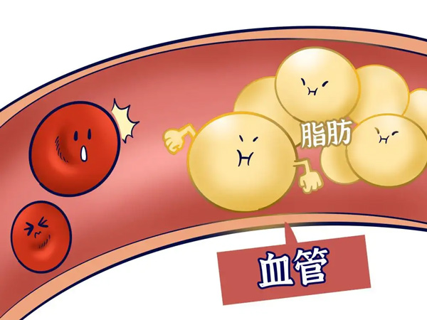 【心腦血管疾病防治行動(dòng)】這些高血脂的誤區(qū)你中了幾個(gè)? 【心腦血管疾病防治行動(dòng)】這些高血脂的誤區(qū)你中了幾個(gè)?