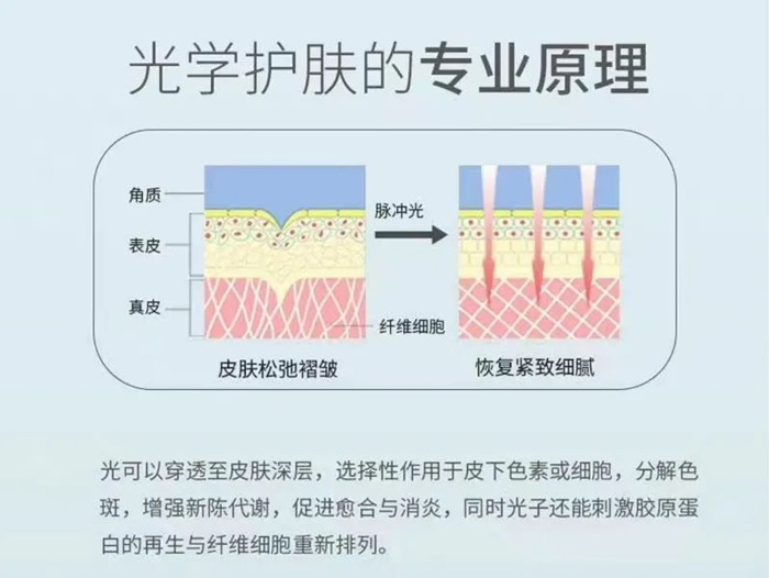 光子嫩膚怎么做?愛美的你要注意這幾點(diǎn)~ 光子嫩膚怎么做?愛美的你要注意這幾點(diǎn)~