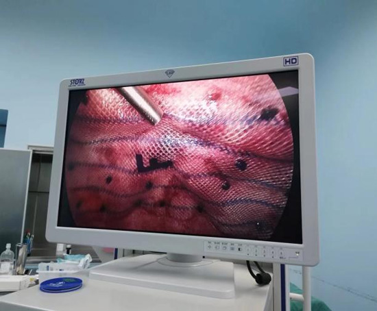 腹部鼓包 妙手修“疝” 腹部鼓包 妙手修“疝”