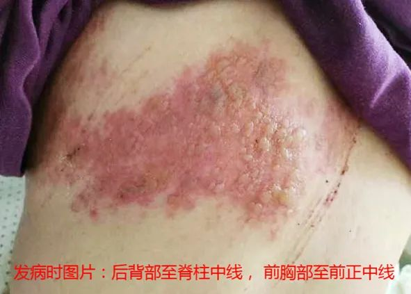 “蛇纏腰”痛起來像被100個(gè)容嬤嬤拿針扎? “蛇纏腰”痛起來像被100個(gè)容嬤嬤拿針扎?