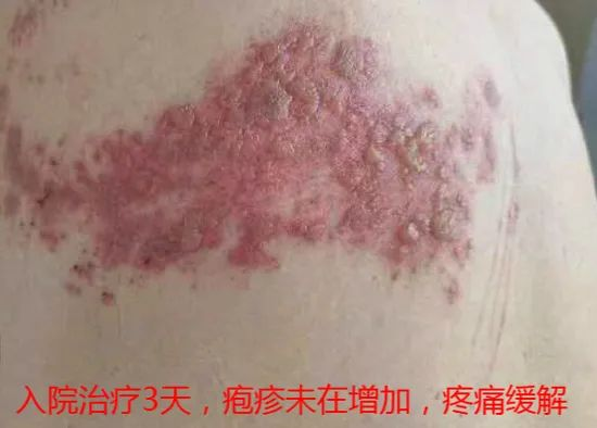 “蛇纏腰”痛起來像被100個(gè)容嬤嬤拿針扎? “蛇纏腰”痛起來像被100個(gè)容嬤嬤拿針扎?