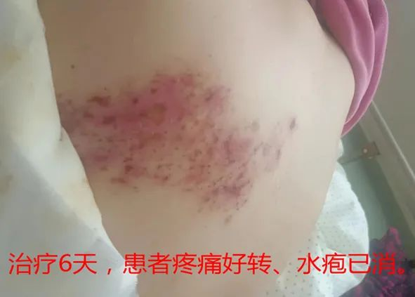 “蛇纏腰”痛起來像被100個(gè)容嬤嬤拿針扎? “蛇纏腰”痛起來像被100個(gè)容嬤嬤拿針扎?