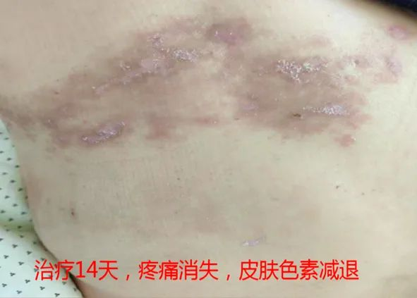 “蛇纏腰”痛起來像被100個(gè)容嬤嬤拿針扎? “蛇纏腰”痛起來像被100個(gè)容嬤嬤拿針扎?