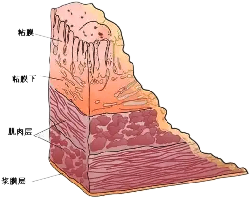 胃癌來(lái)時(shí)“靜悄悄”?這項(xiàng)檢查“揪出它”~ 胃癌來(lái)時(shí)“靜悄悄”?這項(xiàng)檢查“揪出它”~