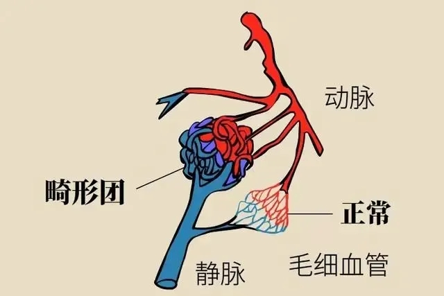 從頭痛到腦出血,一個(gè)13歲女孩的驚心歷險(xiǎn)記,發(fā)人深醒! 從頭痛到腦出血,一個(gè)13歲女孩的驚心歷險(xiǎn)記,發(fā)人深醒!