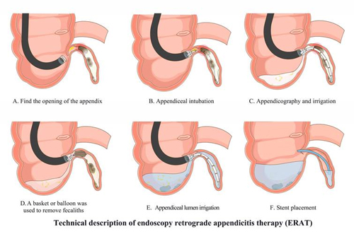 在那個(gè)“被遺忘”的腸道角落里,是否潛藏著不為所知的健康密碼? 在那個(gè)“被遺忘”的腸道角落里,是否潛藏著不為所知的健康密碼?