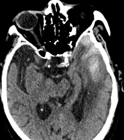 “事發(fā)突然”,專家團(tuán)隊(duì)精準(zhǔn)微創(chuàng),從容應(yīng)對(duì)助康復(fù) “事發(fā)突然”,專家團(tuán)隊(duì)精準(zhǔn)微創(chuàng),從容應(yīng)對(duì)助康復(fù)